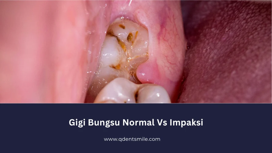 Mengenal Bahaya Gigi Impaksi: Ketika Gigi Bungsu Tak Punya Tempat Mengenal Bahaya Gigi Impaksi